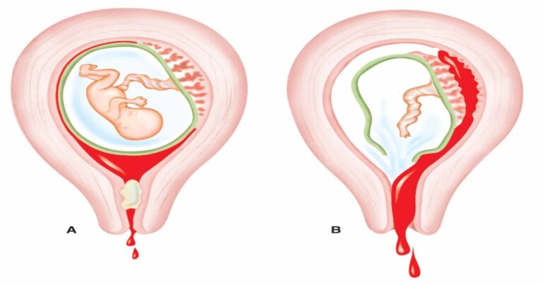 Causes Of Bleeding After Using Abortion Pills Available In UAE