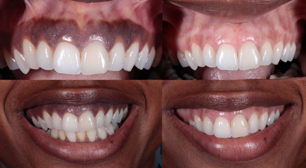 Gums Depigmented? Here’s What You Need To Know