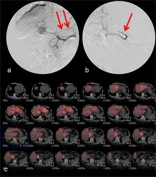 Radioembolization Y-91 Alamogordo – MRI Uses Short-Bore, Whole-Body Imaging System