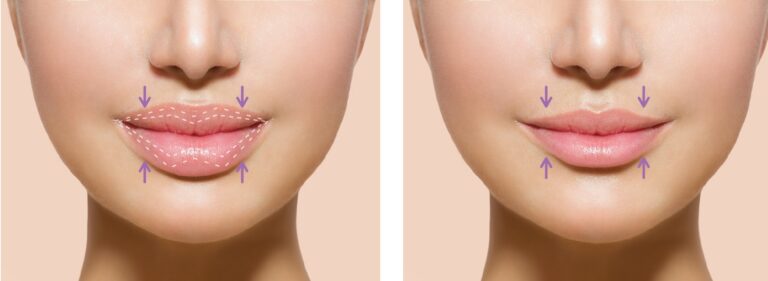 Top Lip ReductionSurgery: What You Need To Know
