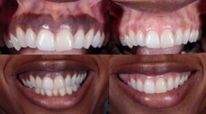 Dark Gums: A Symptom Of Gingivitis Or Something More?