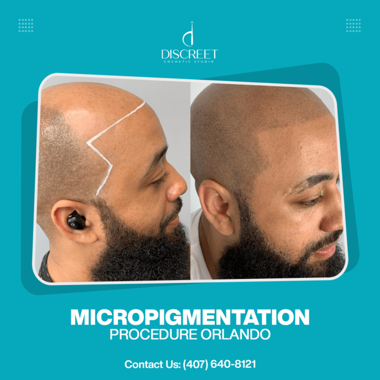 Tips To Choose the Best Scalp Micropigmentation Practitioner