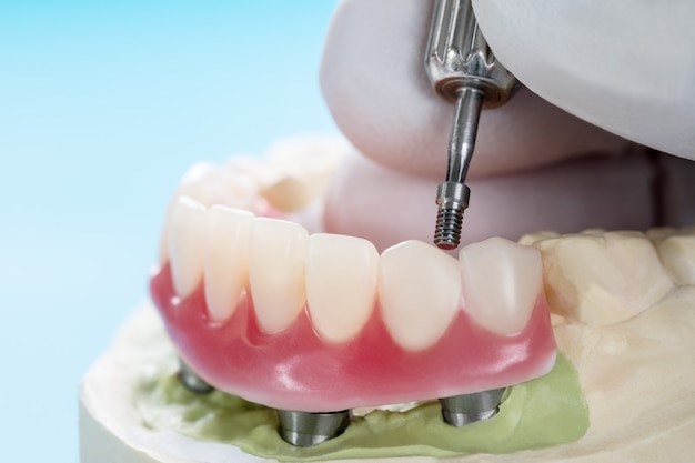 implant supported dentures