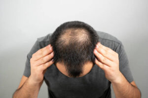 Why You Should Consider Getting a Hair Transplant in Dubai