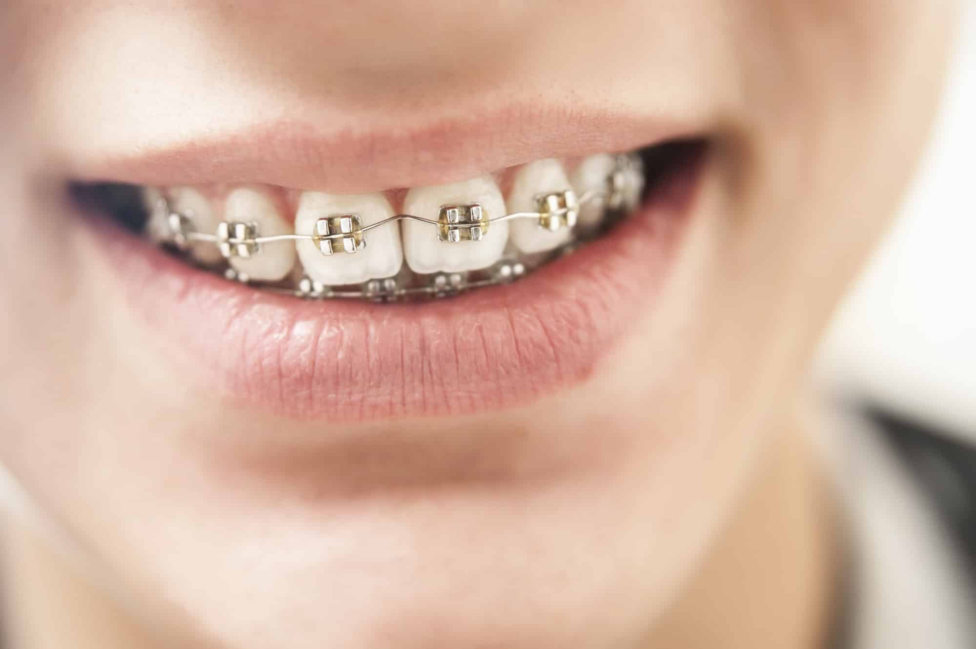 Explanation of the Critical Importance of Getting Braces as an Adult